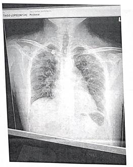 Imagen 1. Radiografía de opacidades bilaterales de predominio apical, tipo 2 de la Clasificación Internacional de la OIT